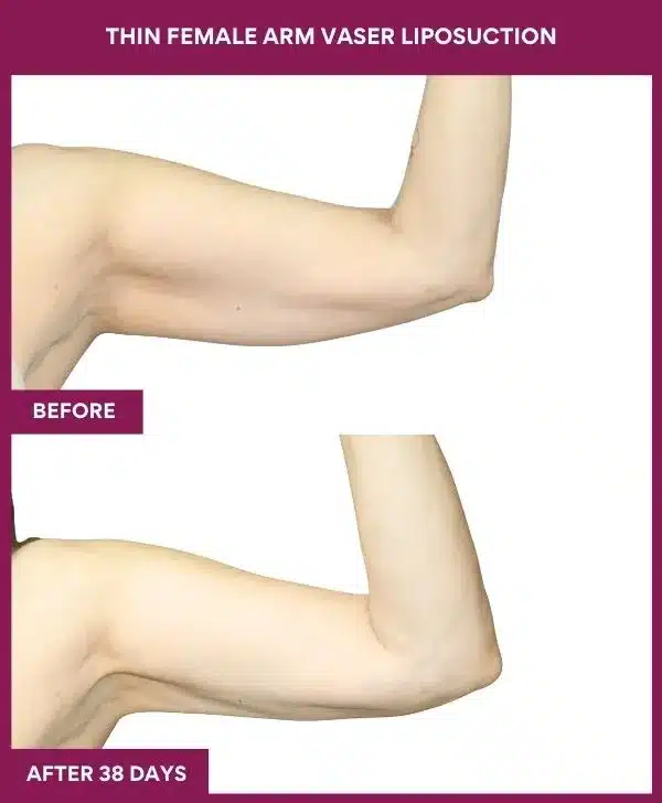 Liposuction Before After Gallery 114 THIN FEMALE ARM VASER LIPOSUCTION in Mumbai, India