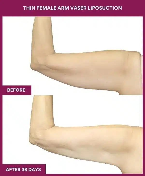 Liposuction Before After Gallery 115 THIN FEMALE ARM VASER LIPOSUCTION in Mumbai, India