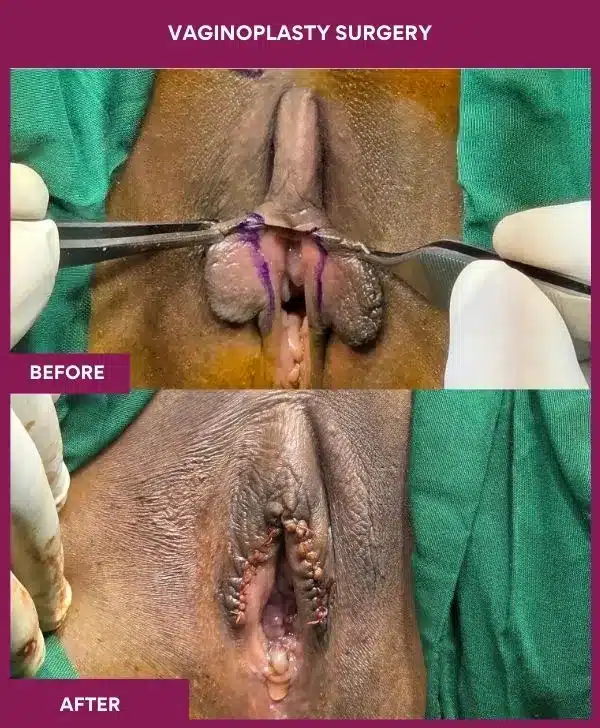 vaginoplasty surgery in Mumbai, India