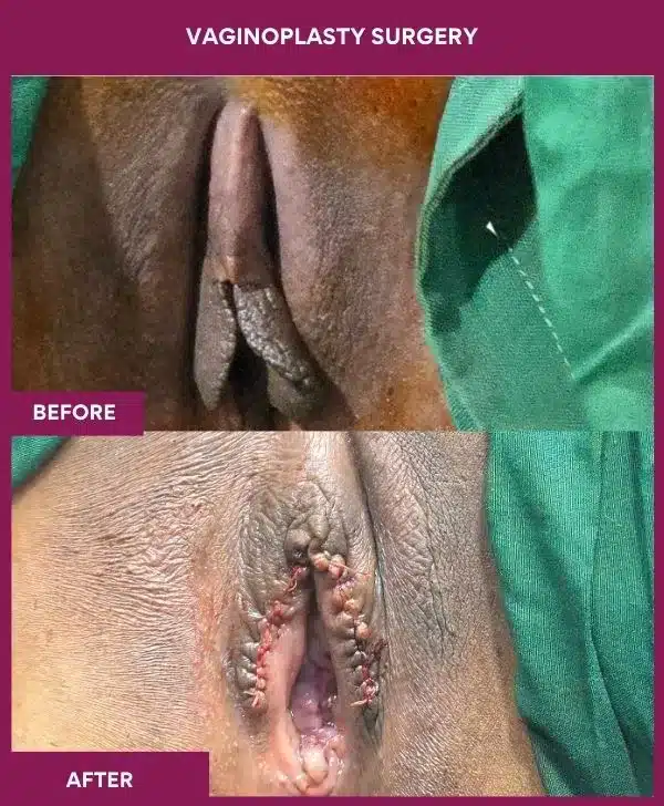 vaginoplasty surgery in Mumbai, India