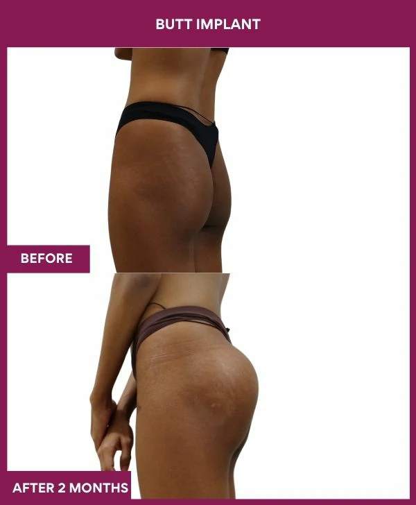 Buttock Augmentation Surgery 19 1 BUTT implant (2)