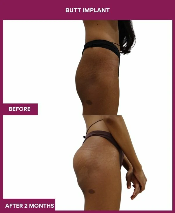 Buttock Augmentation Surgery 20 1 BUTT implant (3)