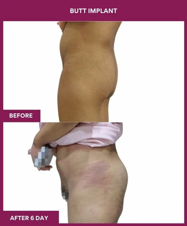 Buttock Augmentation Surgery 25 2 BUTT implant (2)