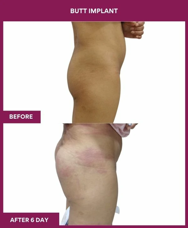 Buttock Augmentation Surgery 23 2 BUTT implant (3)