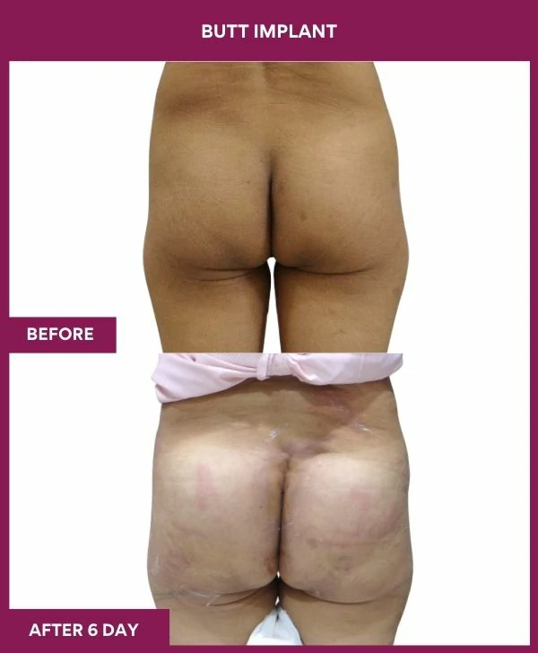 Buttock Augmentation Surgery 24 2 BUTT implant