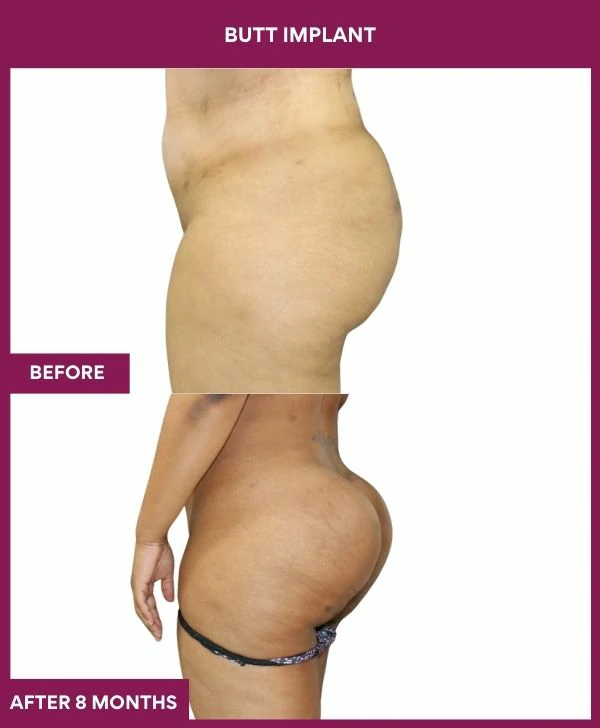 Buttock Augmentation Surgery 28 3 BUTT implant (2)