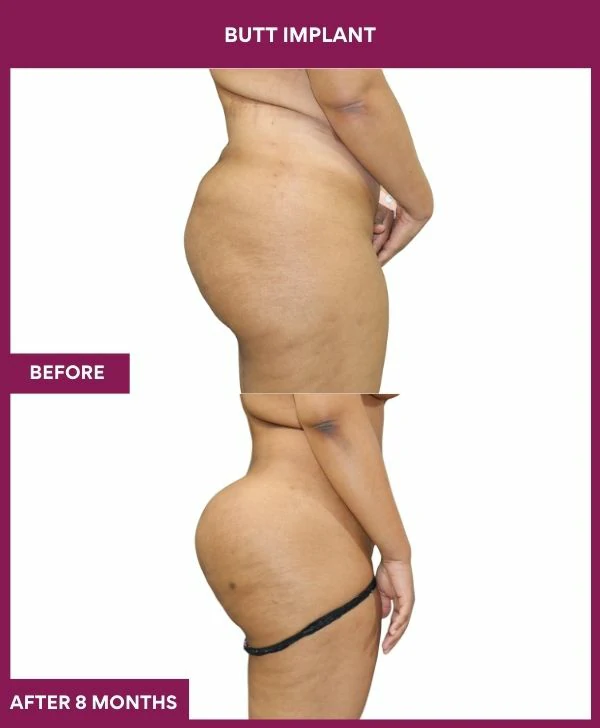 Buttock Augmentation Surgery 26 3 BUTT implant (3)