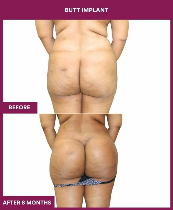 Buttock Augmentation Surgery 27 3 BUTT implant
