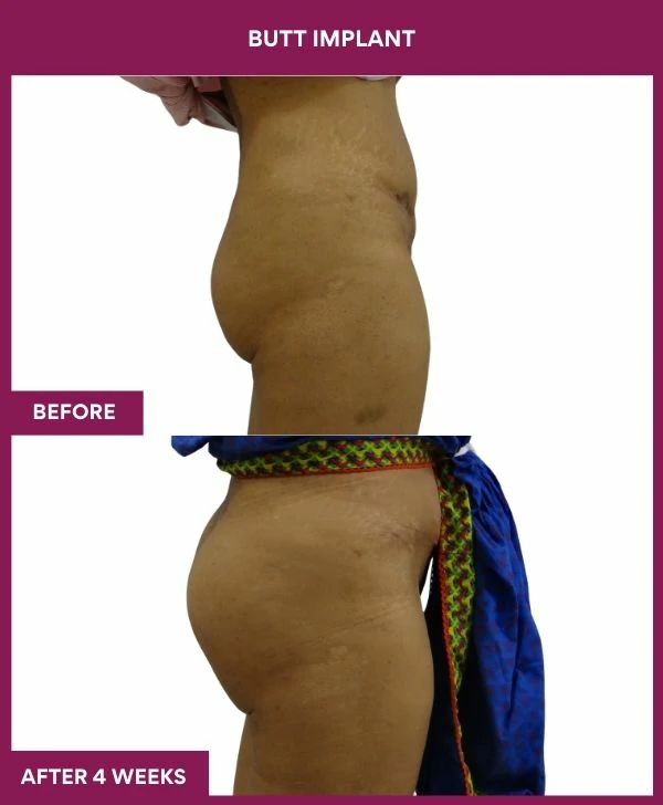 Buttock Augmentation Surgery 29 4 BUTT implant (2)
