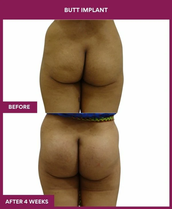 Buttock Augmentation Surgery 30 4 BUTT implant