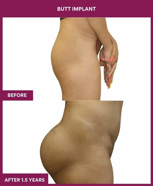 Buttock Augmentation Surgery 32 7 BUTT implant (3)