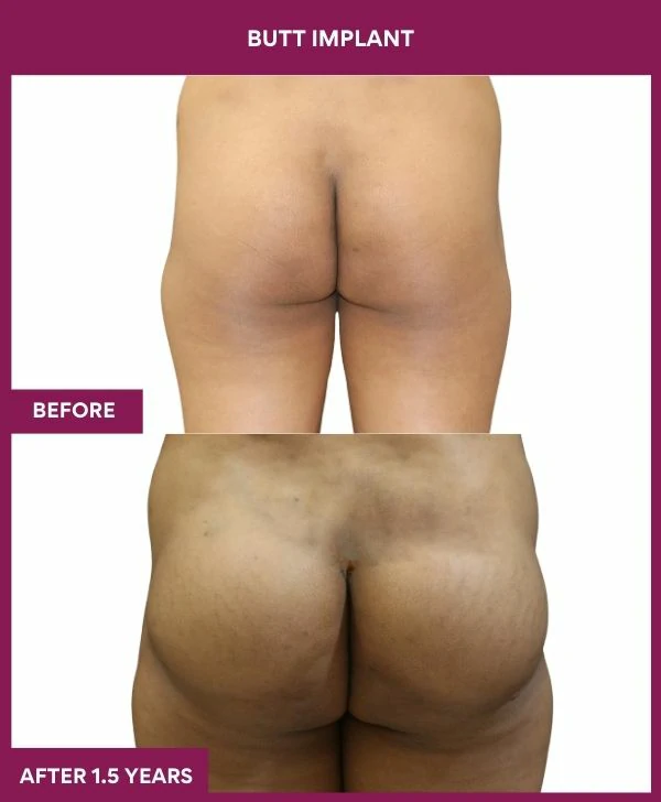 Buttock Augmentation Surgery 33 7 BUTT implant