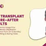 HAIR TRANSPLANT BEFORE–AFTER RESULTS