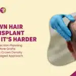 Crown Baldness Hair Transplant in Mumbai, India