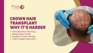 Crown Baldness Hair Transplant in Mumbai, India