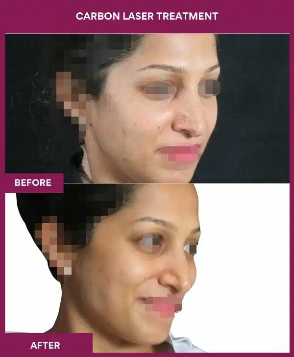 Carbon Laser Treatment Result