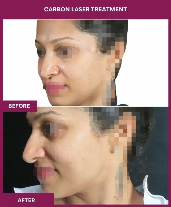 Carbon Laser Treatment Result