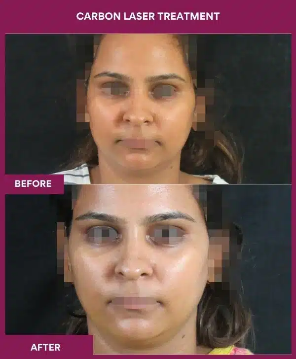 Carbon Laser Treatment in Mumbai