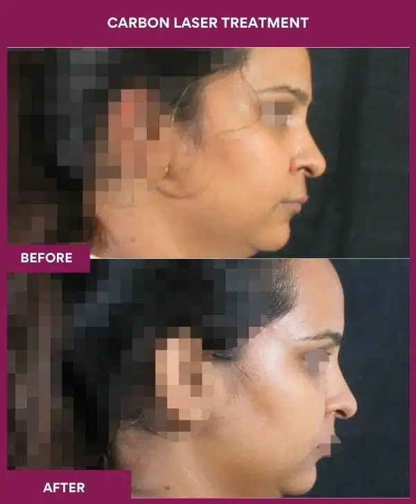 Carbon Laser Treatment in Mumbai