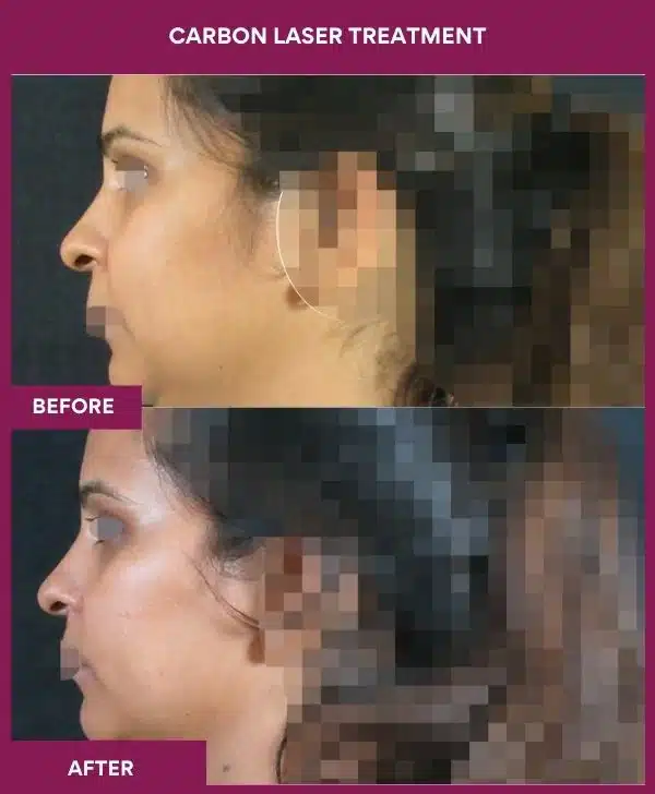 Carbon Laser Treatment in Mumbai