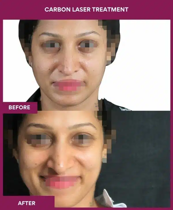 Carbon Laser Treatment Result