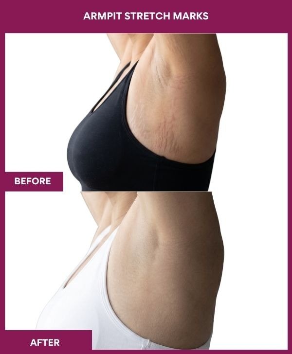 Armpit-stretch-marks-treatment-before-after-results-mumbai-india-patient01