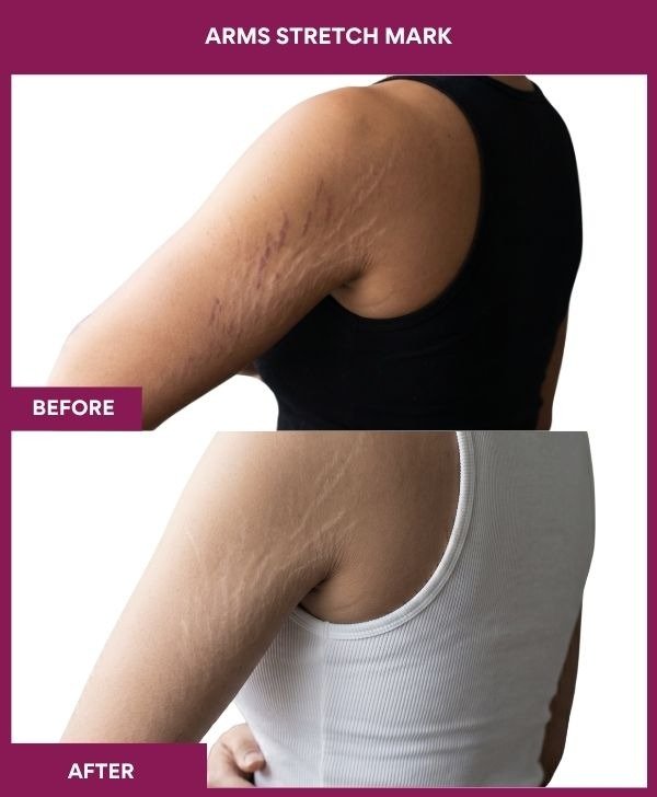 Arms-Stretch-Mark-treatment-before-after-results-mumbai-india-patient02