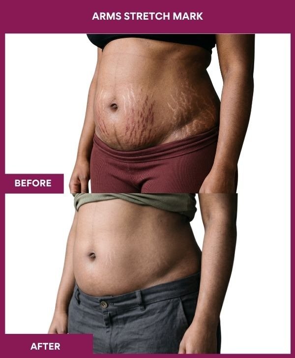 Arms-Stretch-Mark-treatment-before-after-results-mumbai-india-patient03-side-left