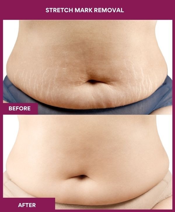 Belly-stretch-mark-remova-treatment-before-after-results-mumbai-india-patient06-front