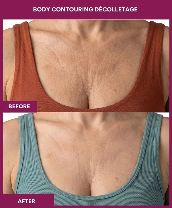 Body-contouring-Décolletage-treatment-before-after-results-mumbai-patient04-front