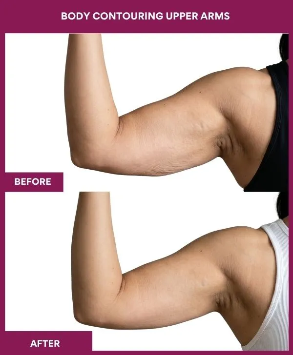 Body-contouring-Upper-Arms-before-after-results-mumbai-patient05-front