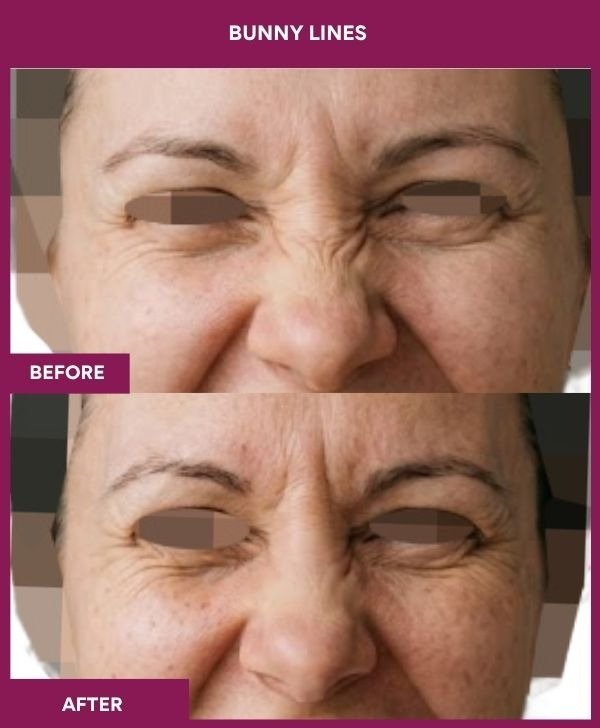 Bunny-Lines-wrinkle-removal-treatment-before-after-results-mumbai-india-patient01-front