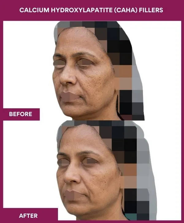 Calcium-Hydroxylapatite-(CaHA)-Fillers-treatment-before-after-results-mumbai-india-patient01-side-left