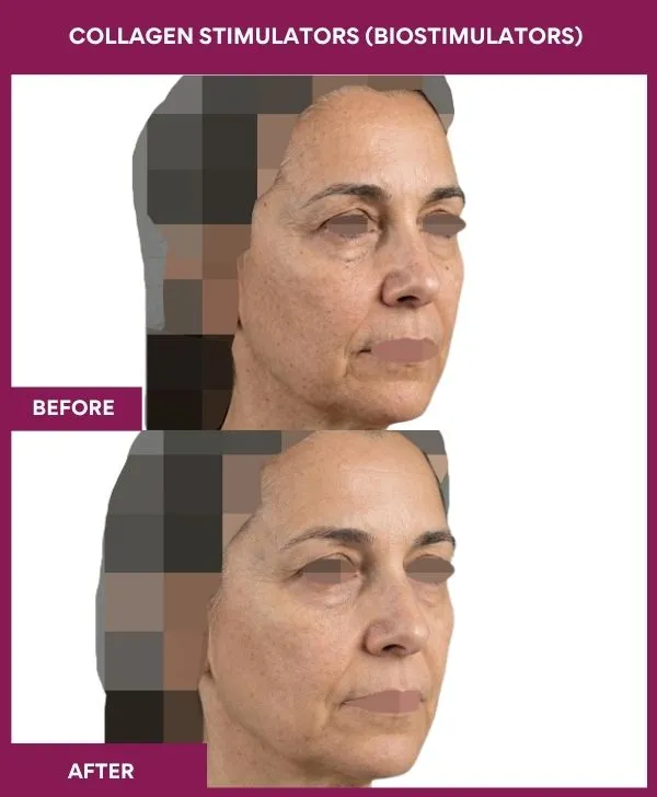 Collagen-Stimulators-(Biostimulators)-treatment-before-after-results-mumbai-patient01-side-right