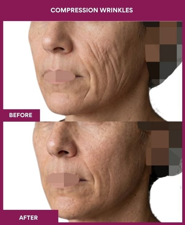 Compression-wrinkle-removal-treatment-before-after-results-mumbai-india-patient02-side-left