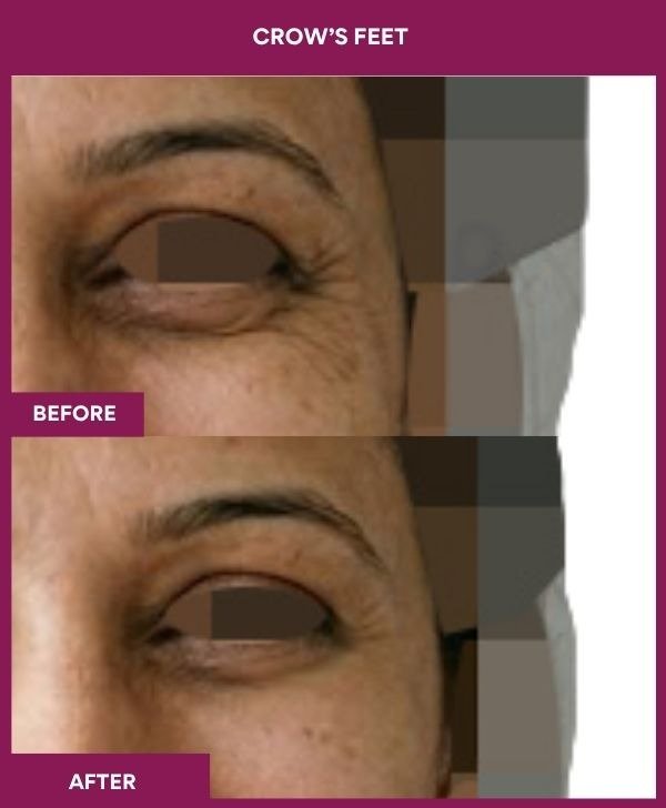 Crow’s-Feet-wrinkle-removal-treatment-before-after-results-india-mumbai-patient03