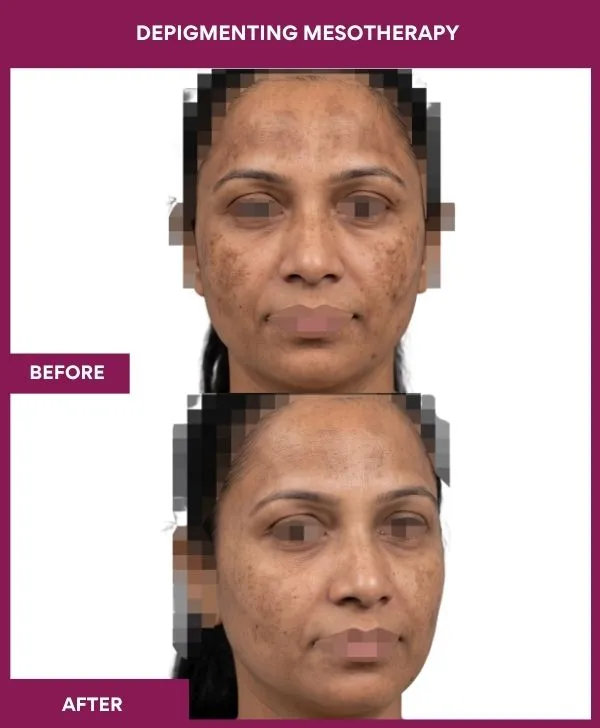 Depigmenting-mesotherapy-treatment-before-after-results-mumbai-patient01
