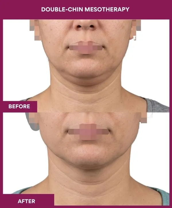 Double-chin-mesotherap-treatment-before-after-results-mumbai-patient02