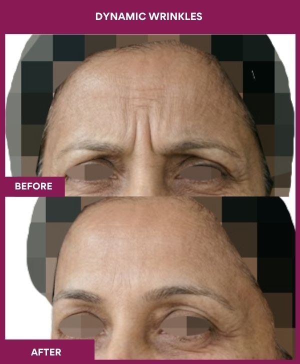 Dynamic-wrinkle-removal-treatment-before-after-results-mumbai-india-patient04-front