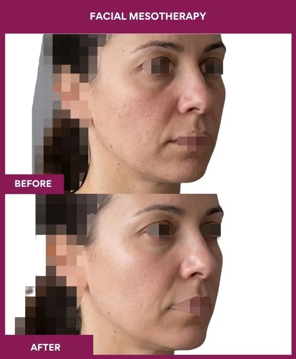 Facial-mesotherapy-treatment-before-after-results-mumbai-patient03