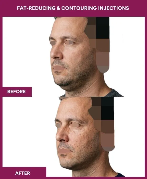 Fat-Reducing-&-Contouring-Injections-treatment-before-after-results-mumbai-patient02-side-left