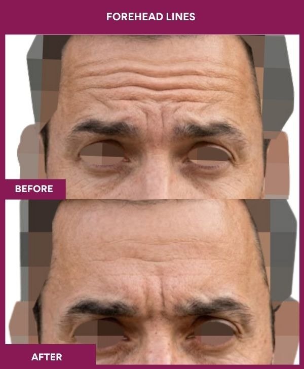 Forehead-Lines-removal-treatment-before-after-results-mumbai-india-patient05-front