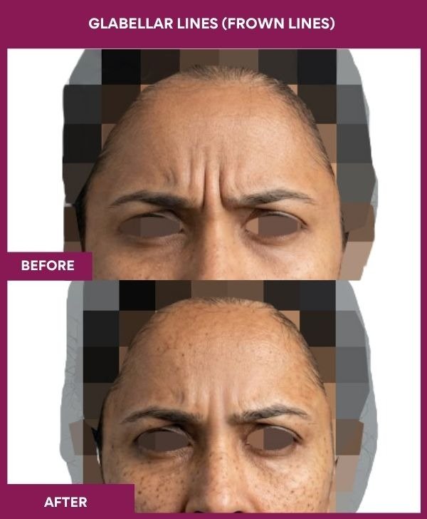 Glabellar-Lines-(Frown-Lines)-removal-treatment-before-after-results-mumbai-india-patient06-front