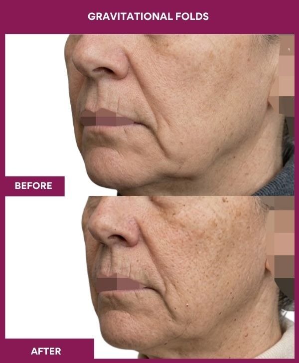 Gravitational-Folds-wrinkle-removal-treatment-before-after-results-mumbai-indiapatient07-side-left