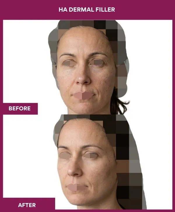 HA-dermal-filler-treatment-before-after-results-mumbai-india-patient02-side-left