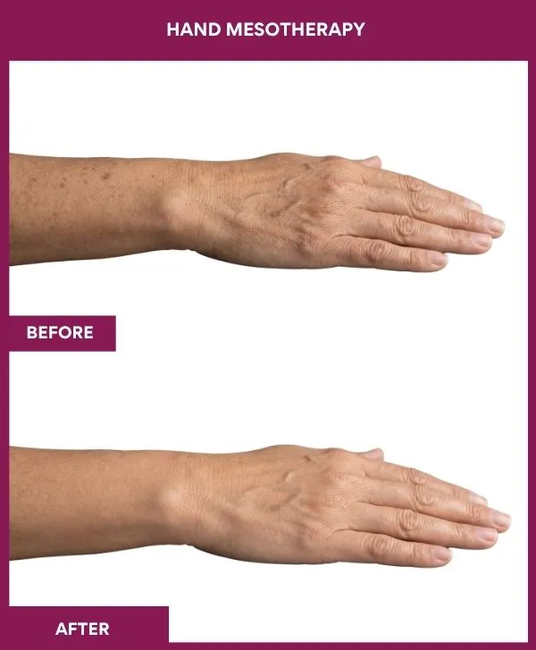 Hand-mesotherapy-treatment-before-after-results-mumbai-patient04