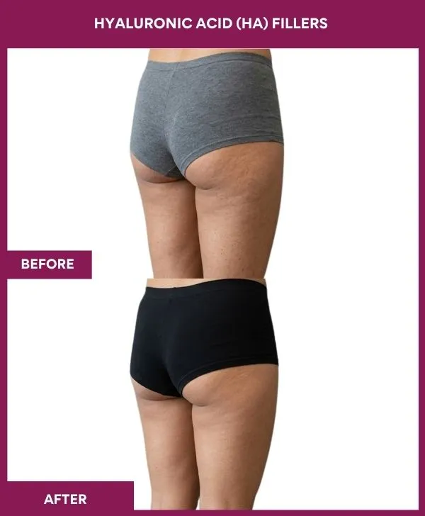 Hyaluronic-Acid-(HA)-Fillers-treatment-before-after-results-mumbai-patient03-butt