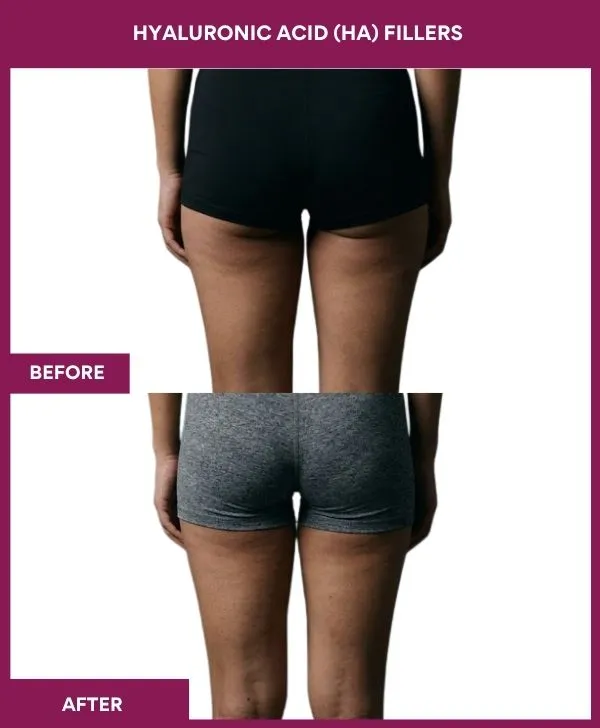 Hyaluronic Acid (HA) Fillers-treatment-before-after-results-mumbai-india-patient03-leg