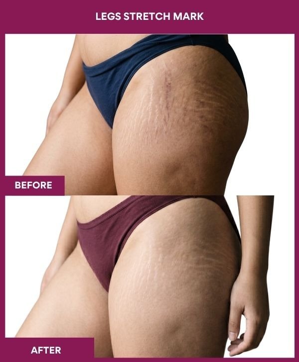 Legs-Stretch-Mark-treatment-before-after-results-india-mumbai-patient04