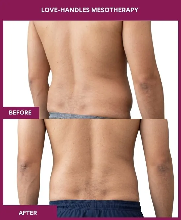 Love-handles-mesotherapy-treatment-before-after-results-mumbai-patient05